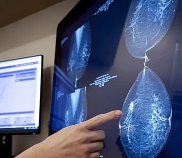 AI Breakthrough: Predicting Breast Cancer Risk—Finally, a Crystal Ball for Your Health!